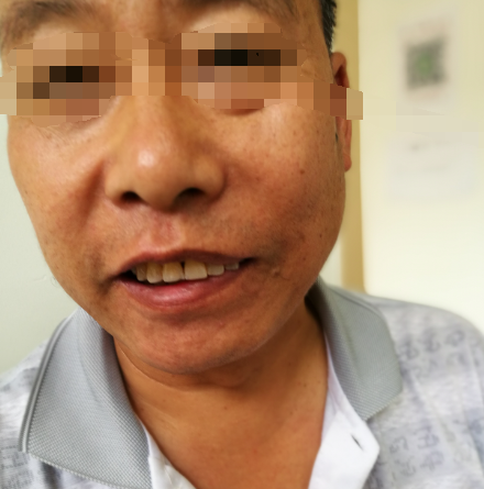 头晕、嘴歪、耳朵痛,是什么病?--耳带状疱疹后