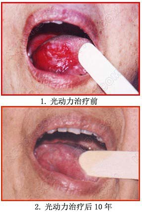 舌癌患者如何正确选择治疗方案 舌癌 手术 放化疗 治疗方法
