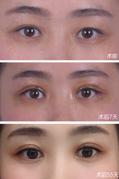 怎么才能有双眼皮 wIYBAFuQ1daAckR5AADZIpwDuSQ429.jpg?_ms_=548f