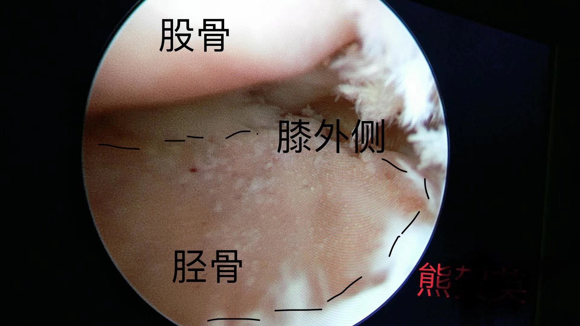 半月板損傷 患者,左膝內側半月板正常,軟骨正常,而外側小腿脛骨