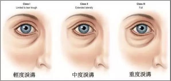 怎样可以去黑眼圈和眼袋 wIYBAFuUhp-APLDYAABJR-rgtlQ835.jpg?_ms_=046d