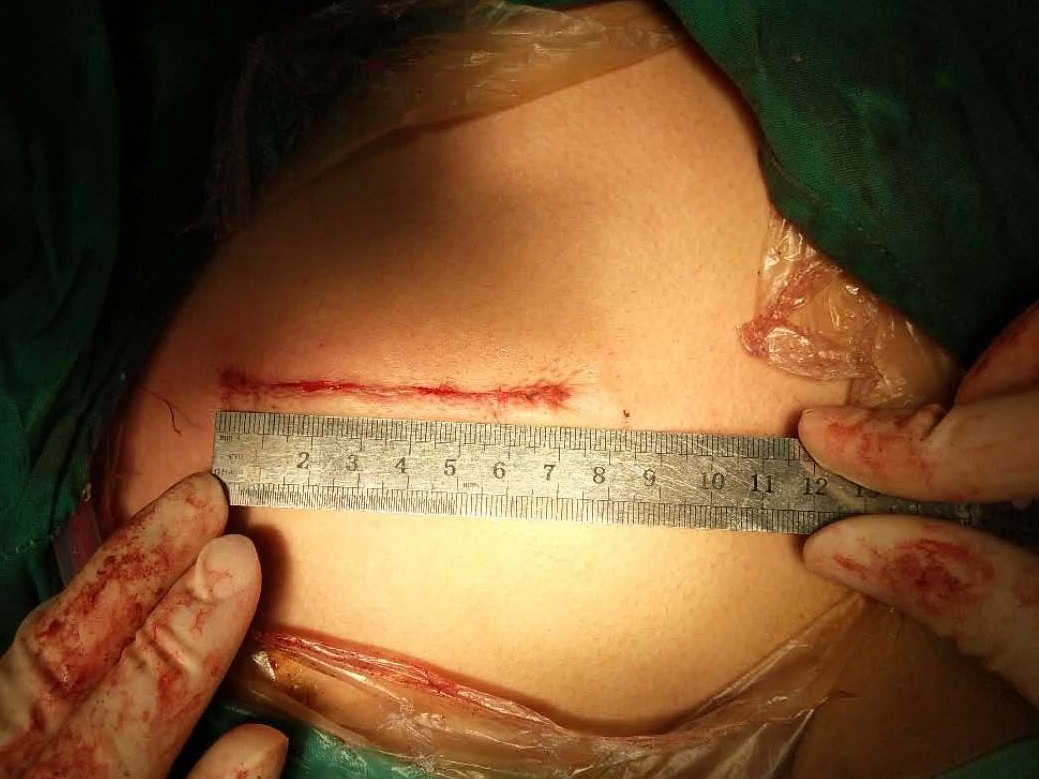 微创小切口换瓣手术治疗主动脉瓣关闭不全和狭窄