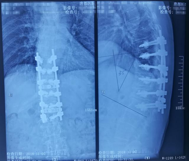 病例分享:胸腰段脊柱后凸畸形 - 好大夫在线