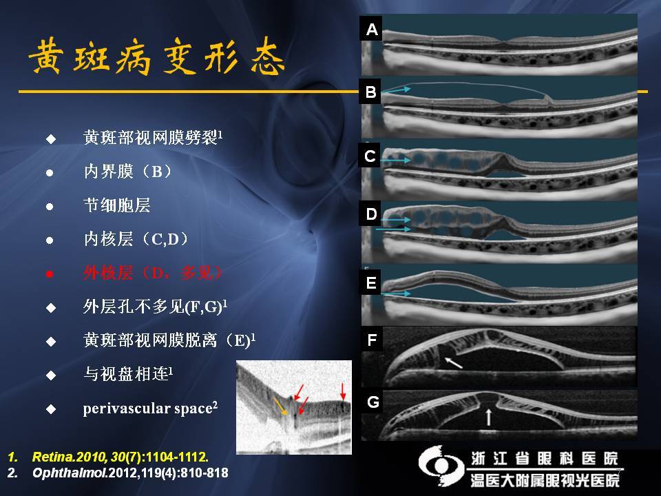 針尖狀的,這種容易漏診,往往患者發生了黃斑劈裂,也會被漏診.