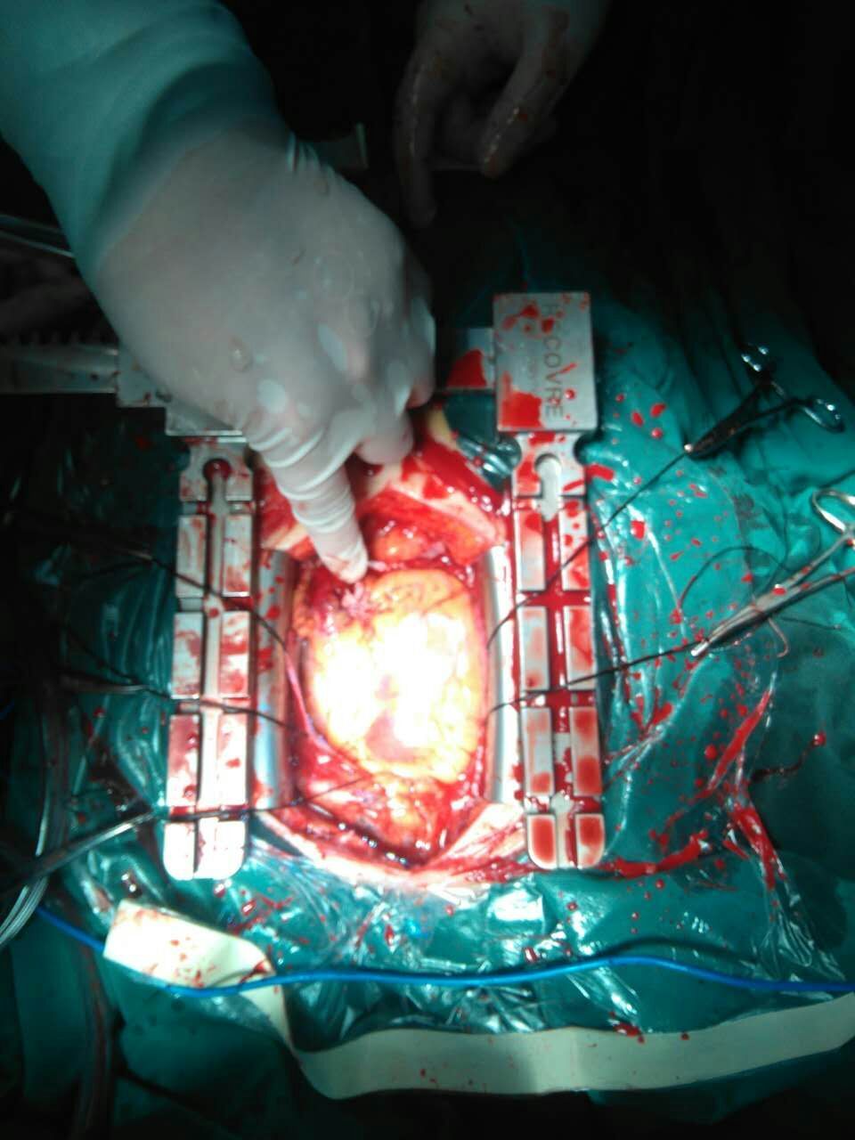 外伤与心脏损伤