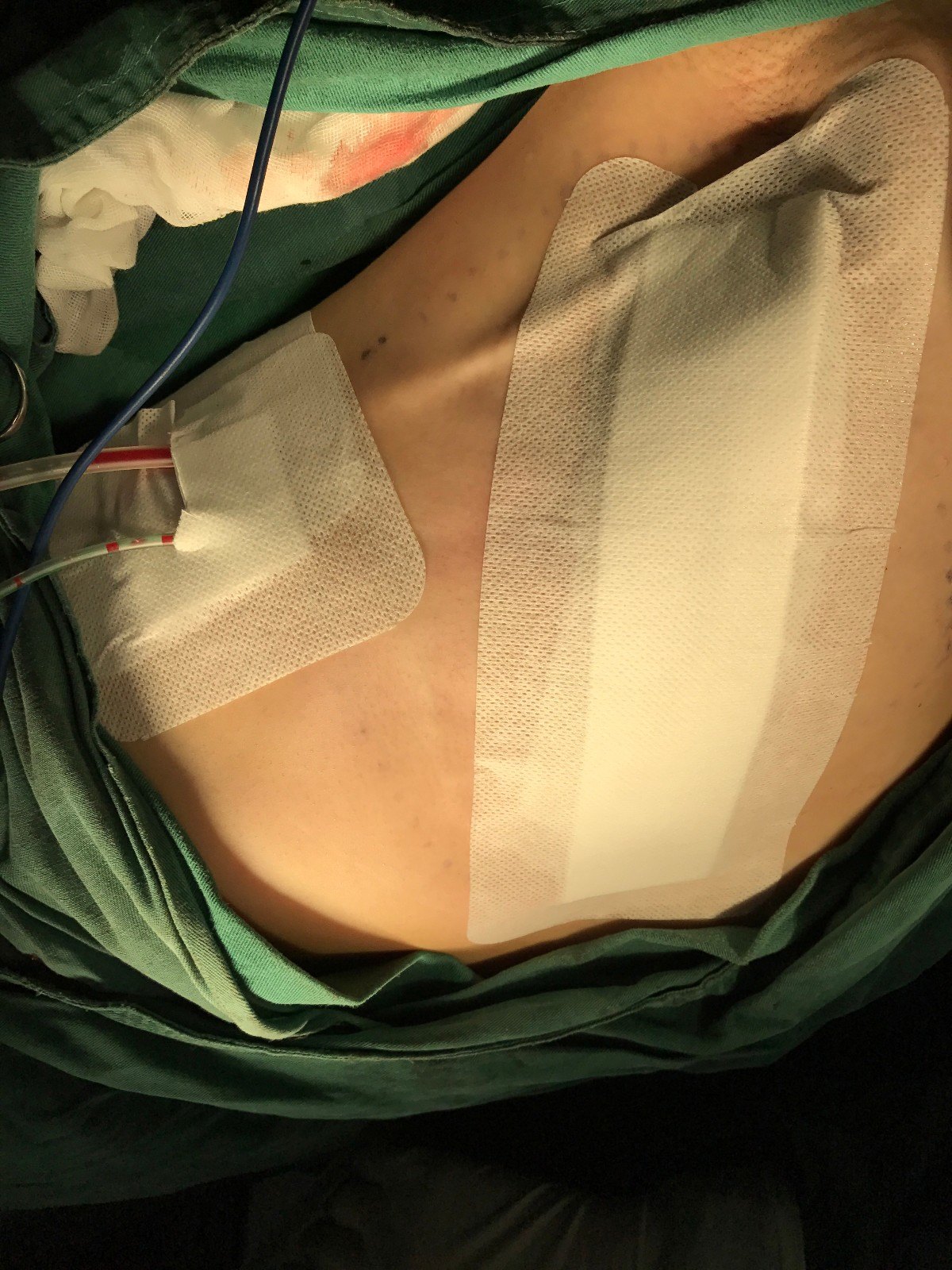 一台标准的乳腺癌改良根治手术应该是怎么样的?