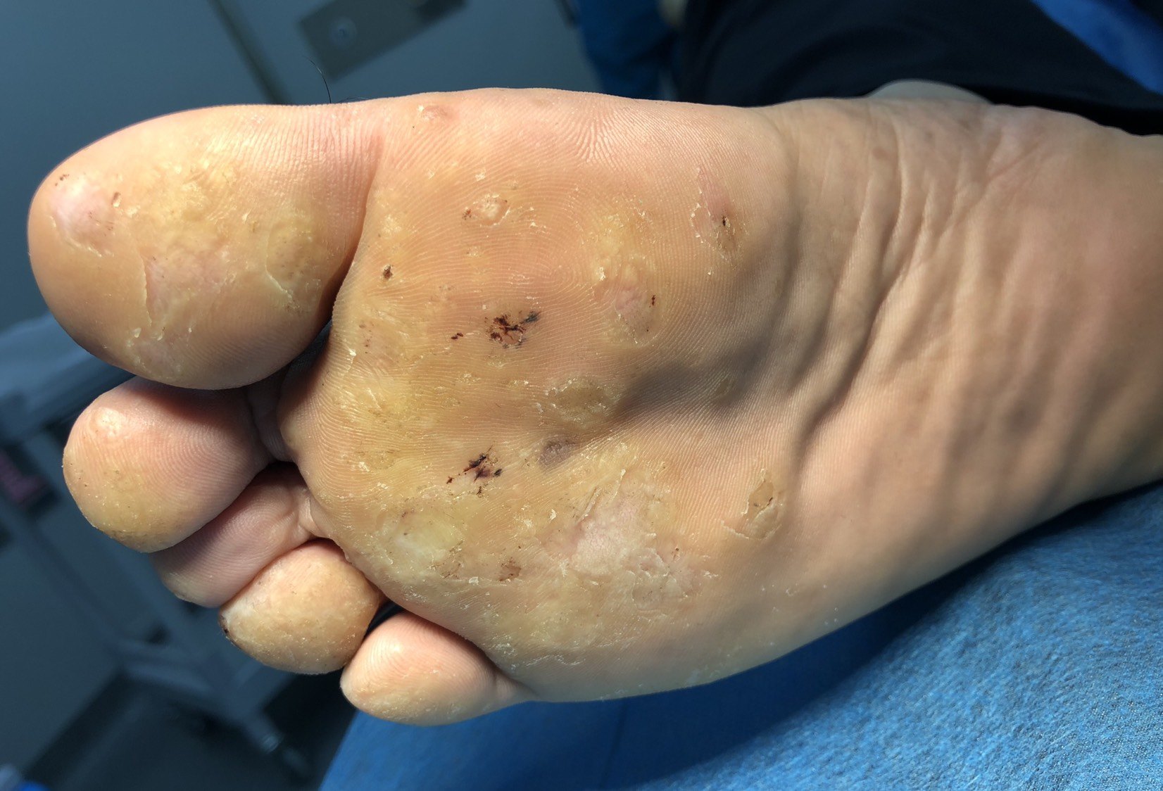 跖疣治疗(削切联合水杨酸治疗)