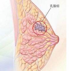 乳腺癌.jpg