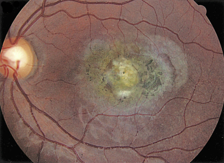 眼球震颤影响视力 眼科治疗增视有术 - 好大夫在线