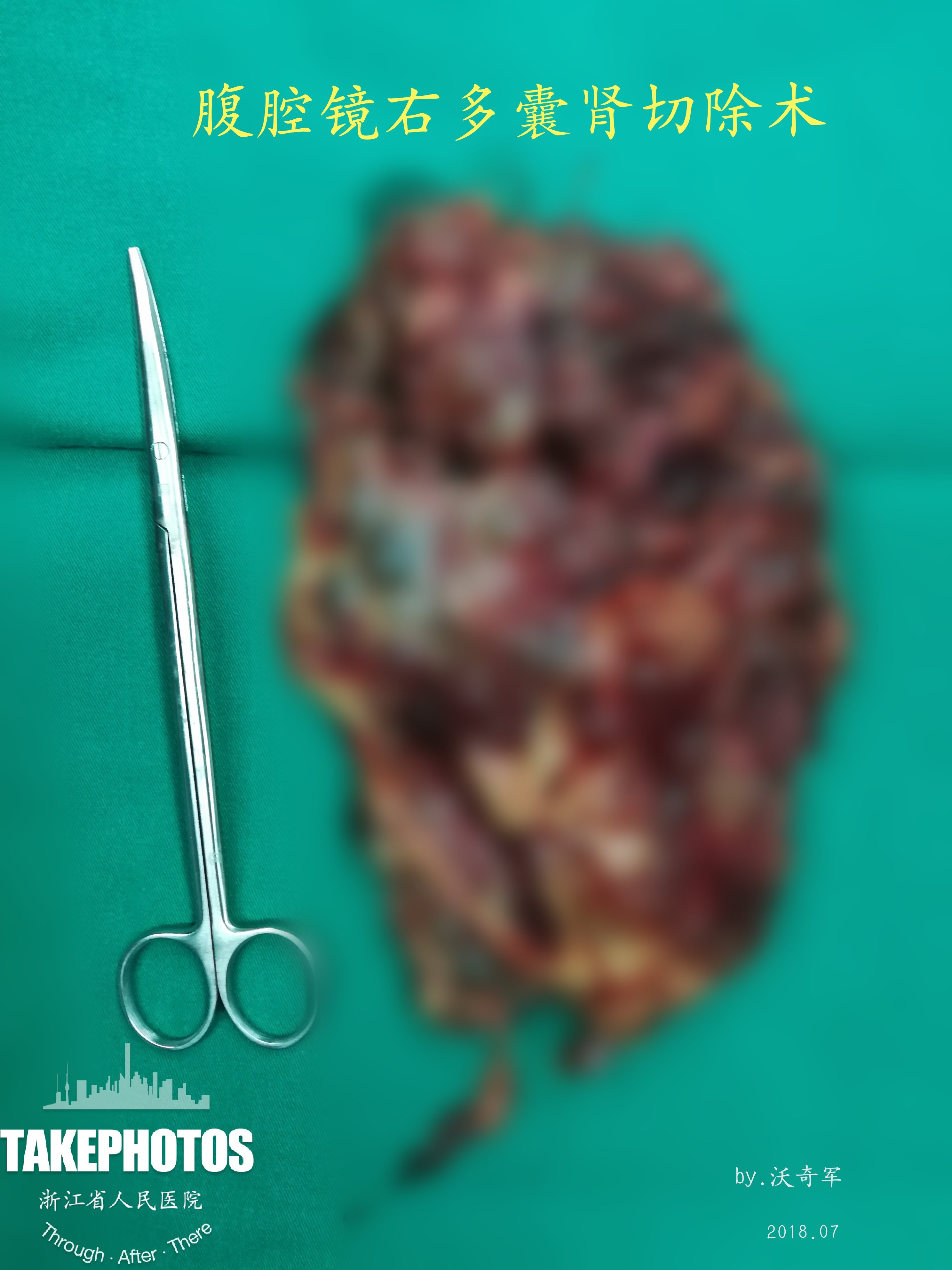 沃医生主刀手术3:腹腔镜多囊肾和脓肾切除