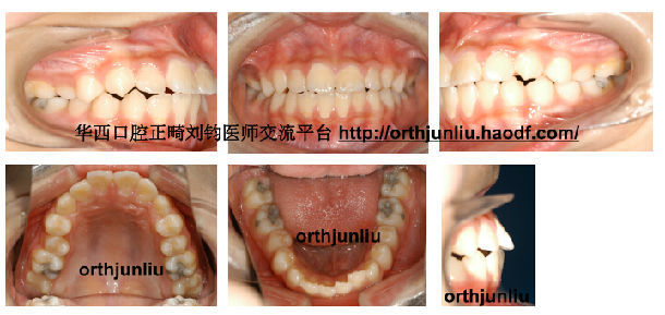 嘴突 拔牙矫治一例 未打骨钉