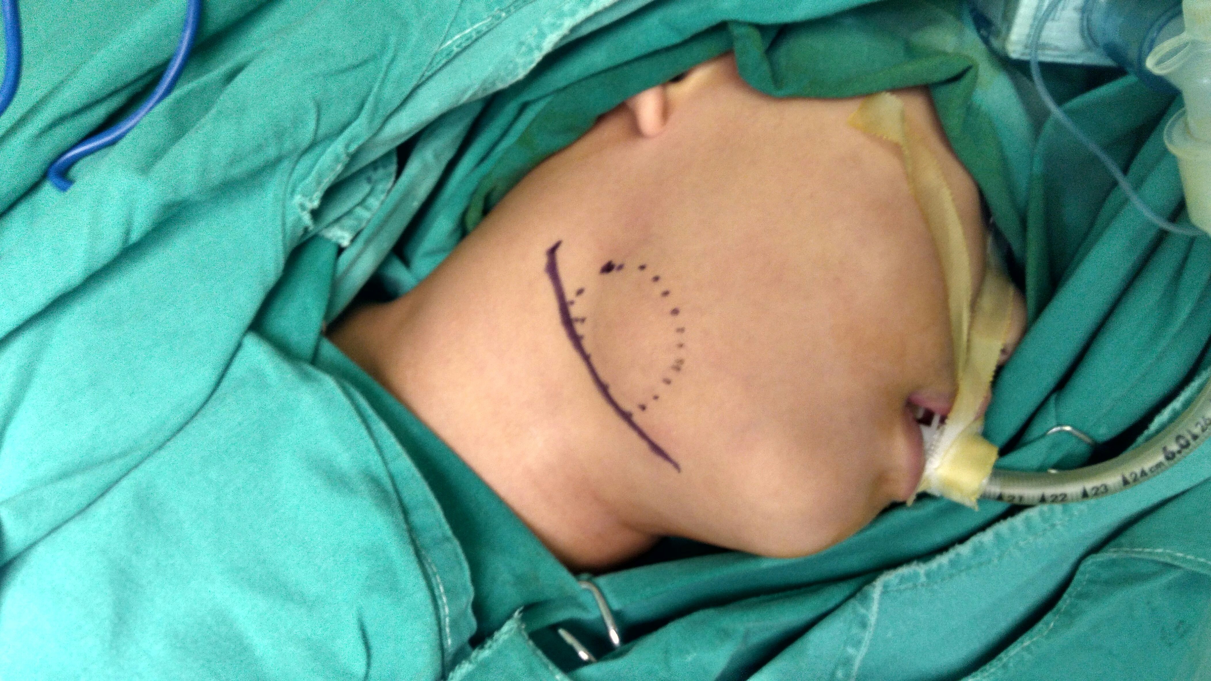 颌下腺结石手术图片