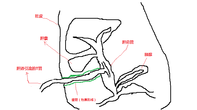 t管窦道形成图片图片