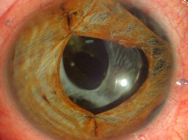 虹膜断离/缺损   瞳孔散大修复的病例