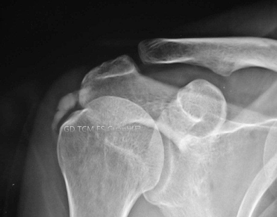 肩痛系列科普之一--肩袖钙化性肌腱炎