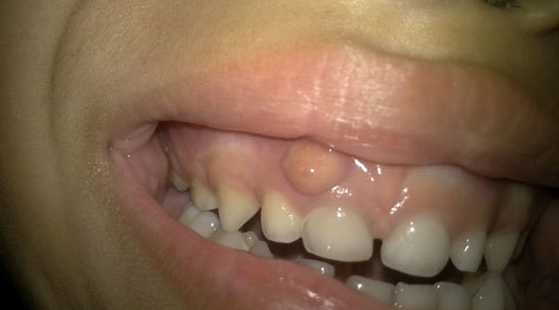 七岁儿童门牙牙龈厚肿图片