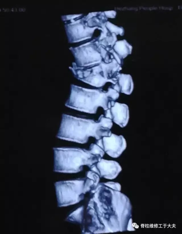 援黔笔记|抵达次日成功救治腰椎爆裂骨折伴双下肢严重不全瘫 - 好大夫