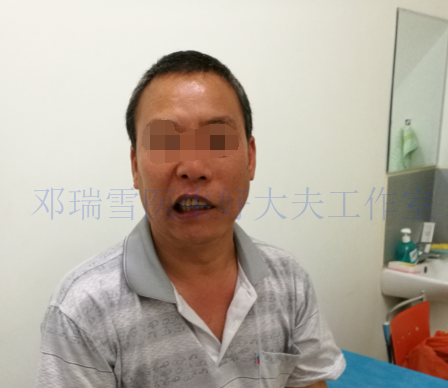 头晕、嘴歪、耳朵痛,是什么病?--耳带状疱疹后