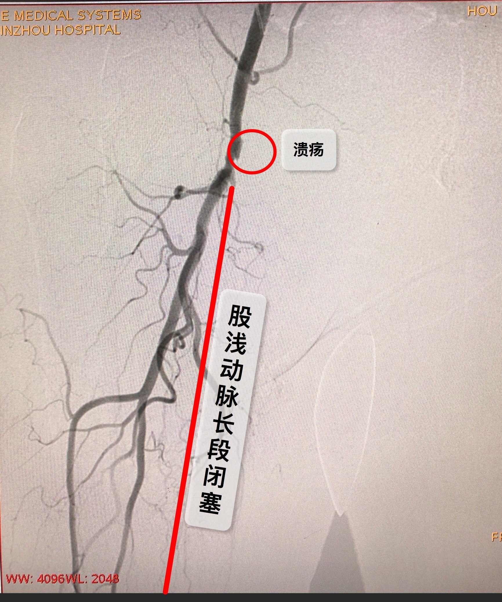 股浅动脉解剖图图片