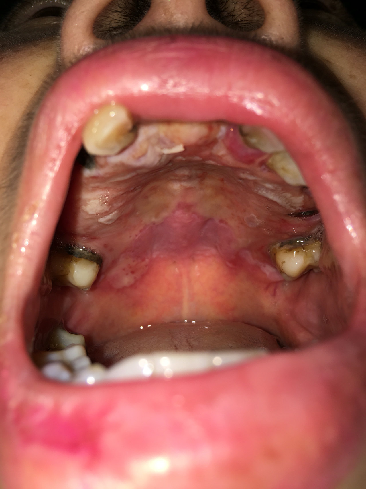 口腔黏膜炎症状图片图片