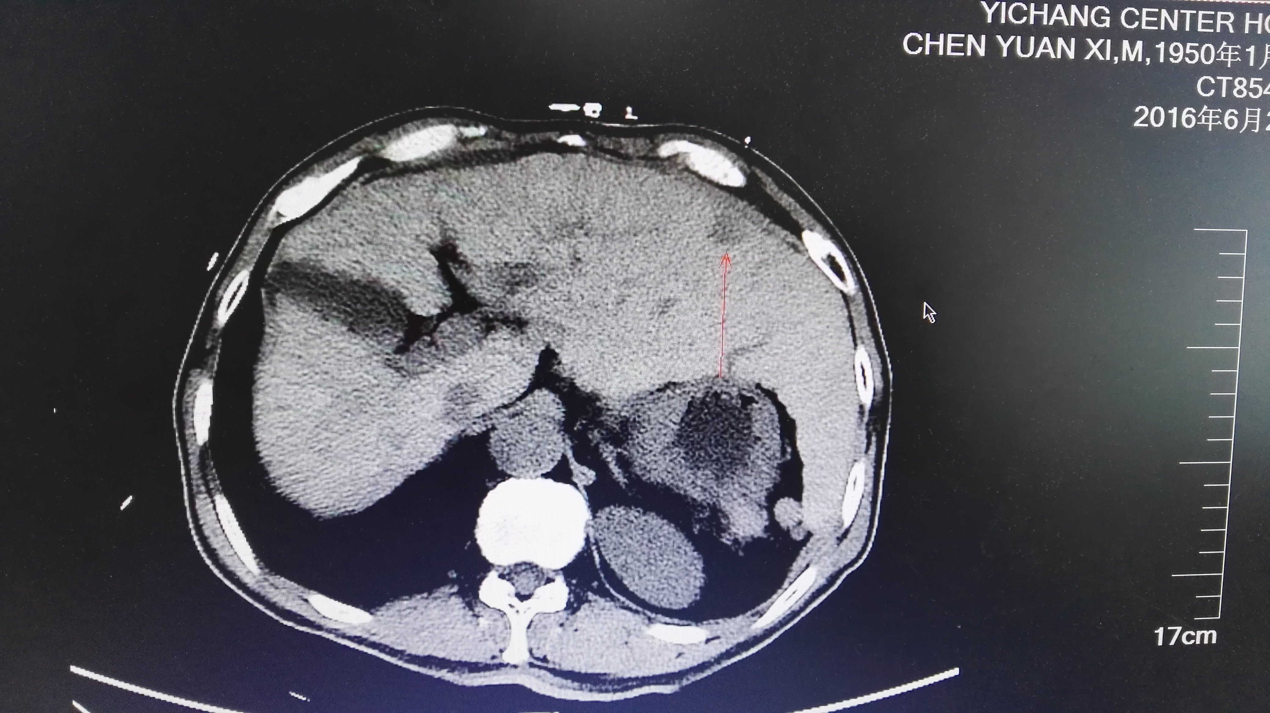 小肝癌微波消融术可达到根治性外科切除效果