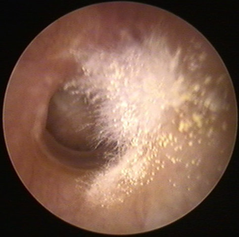 图33-1 外耳道霉菌.jpg