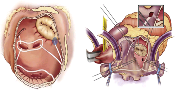 房颤的外科治疗