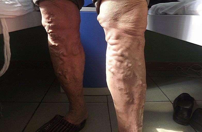 曲的,高出皮肤表面的,如同蚯蚓状突起,这些曲张血管在站立时更为明显