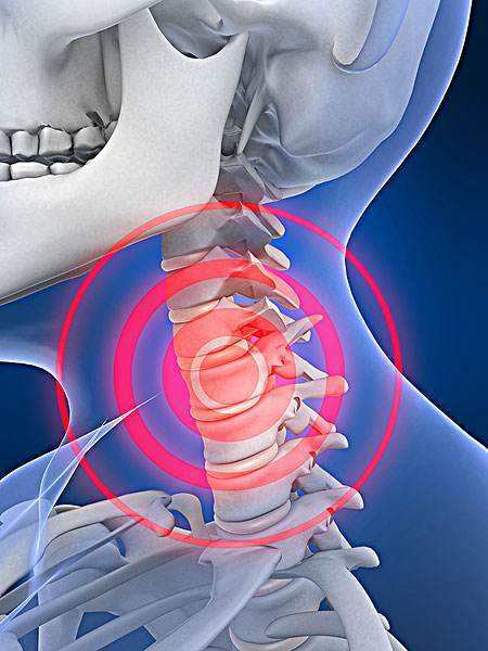 脊髓型頸椎病,椎動脈型頸椎病,交感神經型頸椎病,食管壓迫型
