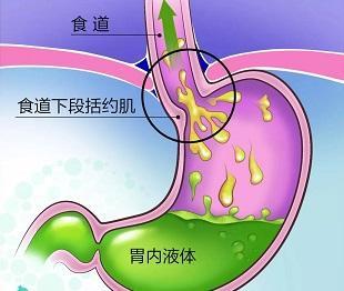 高枕无忧小心胃食管反流病