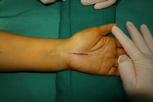 图1 示常规切开松解手术,需要在手腕掌侧切开皮肤及皮下各层组织