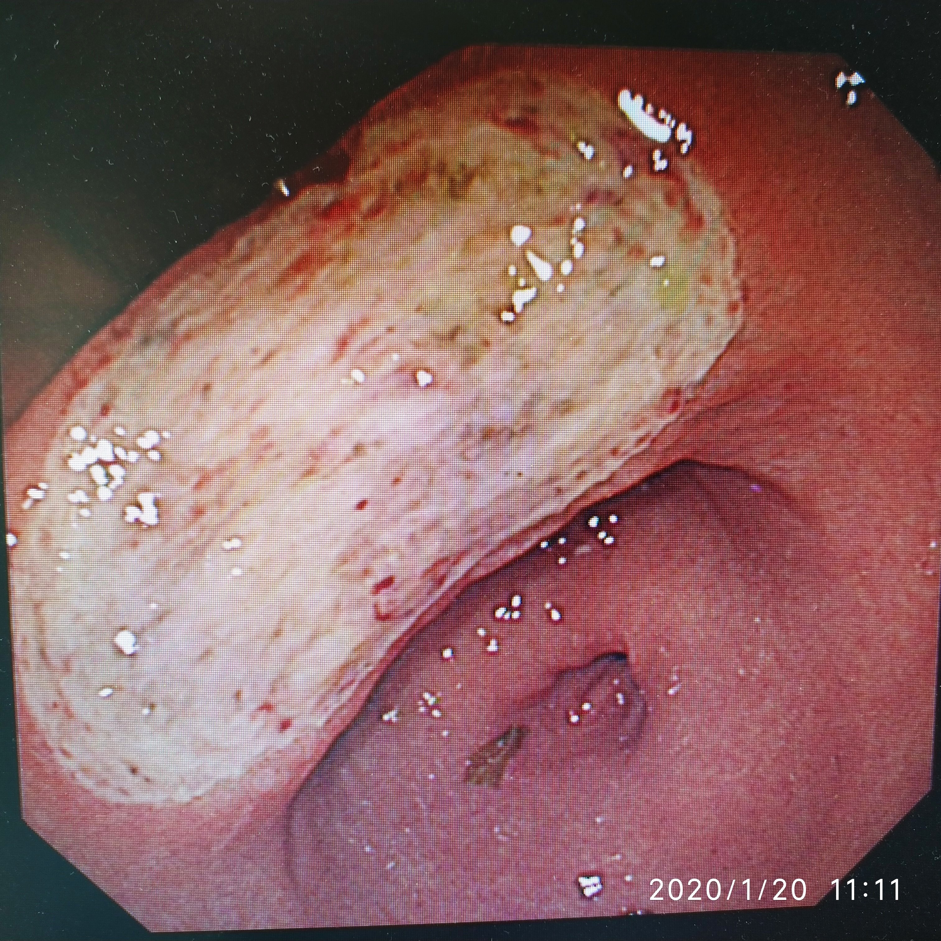 十二指肠溃疡胃镜图片图片