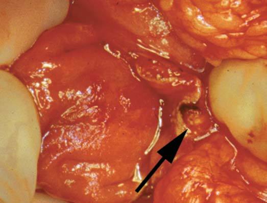 胃泌素瘤gastrinoma