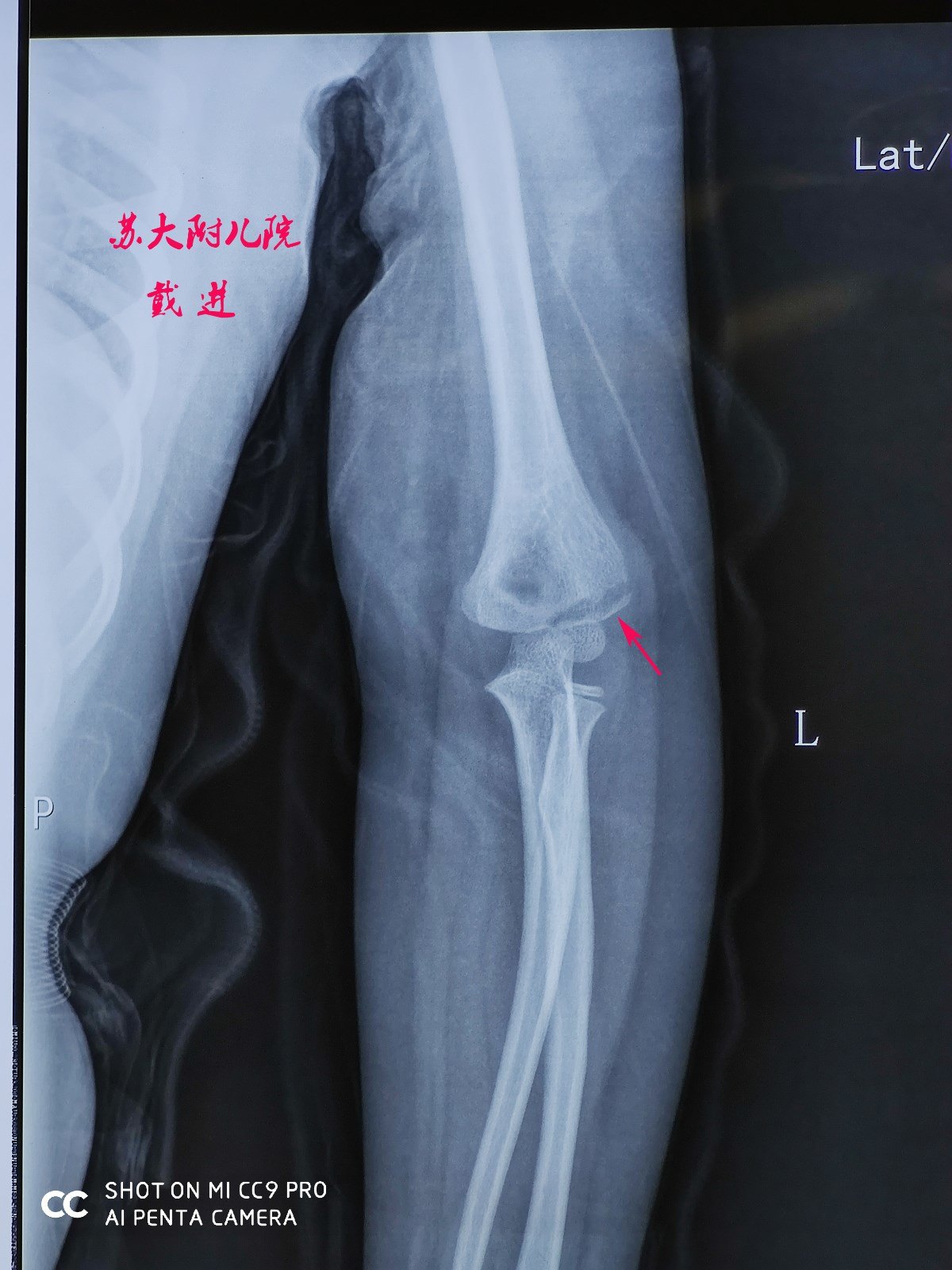 肘关节造影术在儿童肱骨外髁骨折中的应用