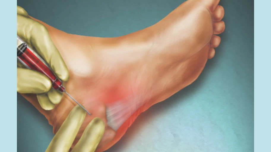 医生,我的封闭针到底打呢还是不打?