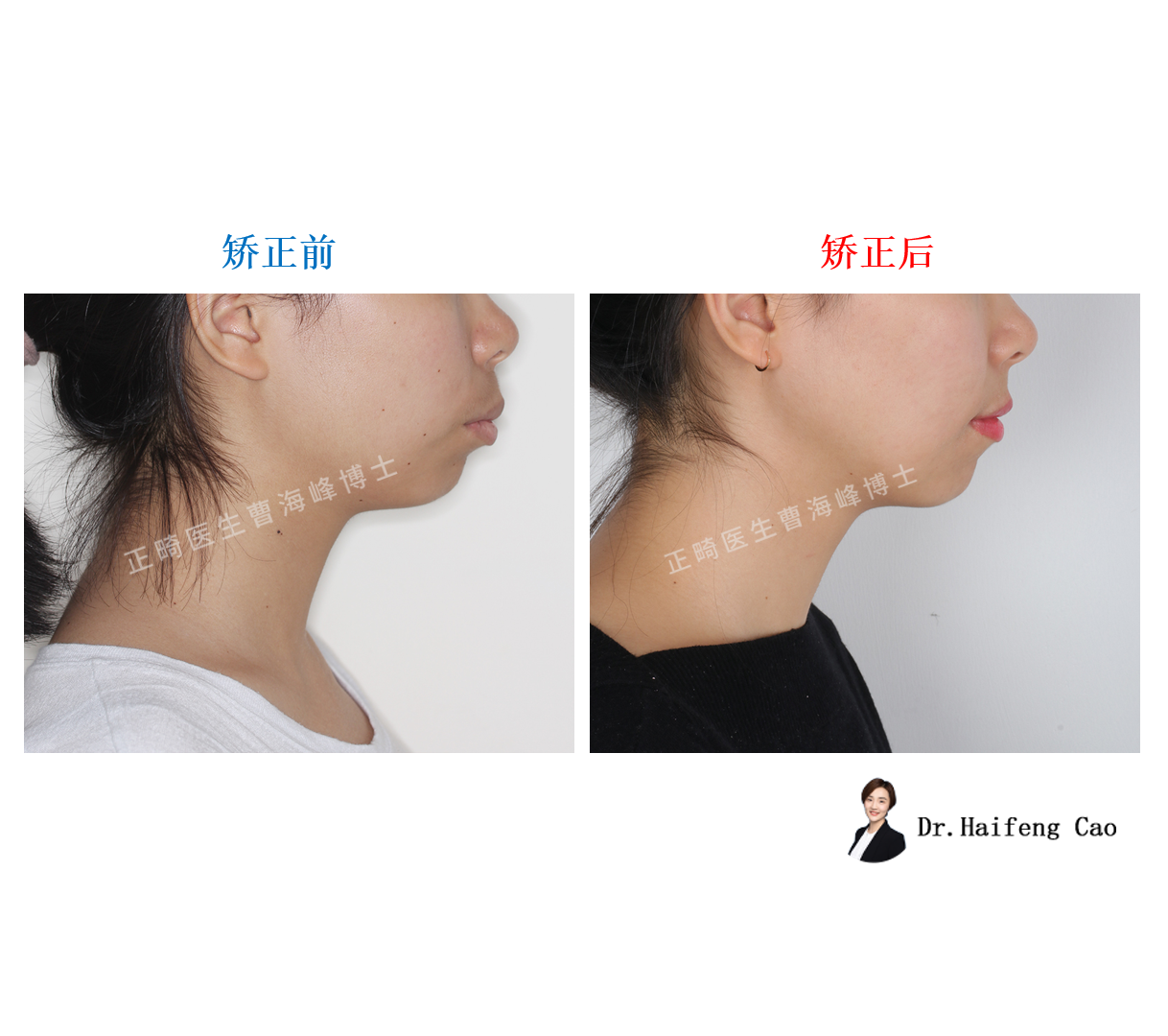 【18岁女生嘴凸矫正案例】 - 好大夫在线