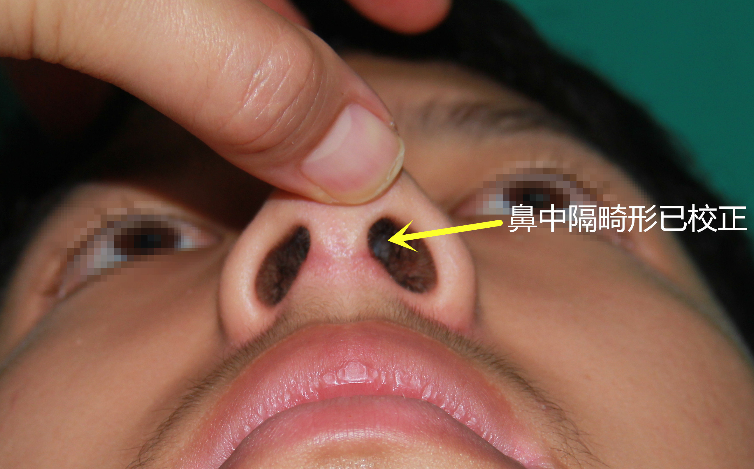 鼻中隔偏曲治疗方式
