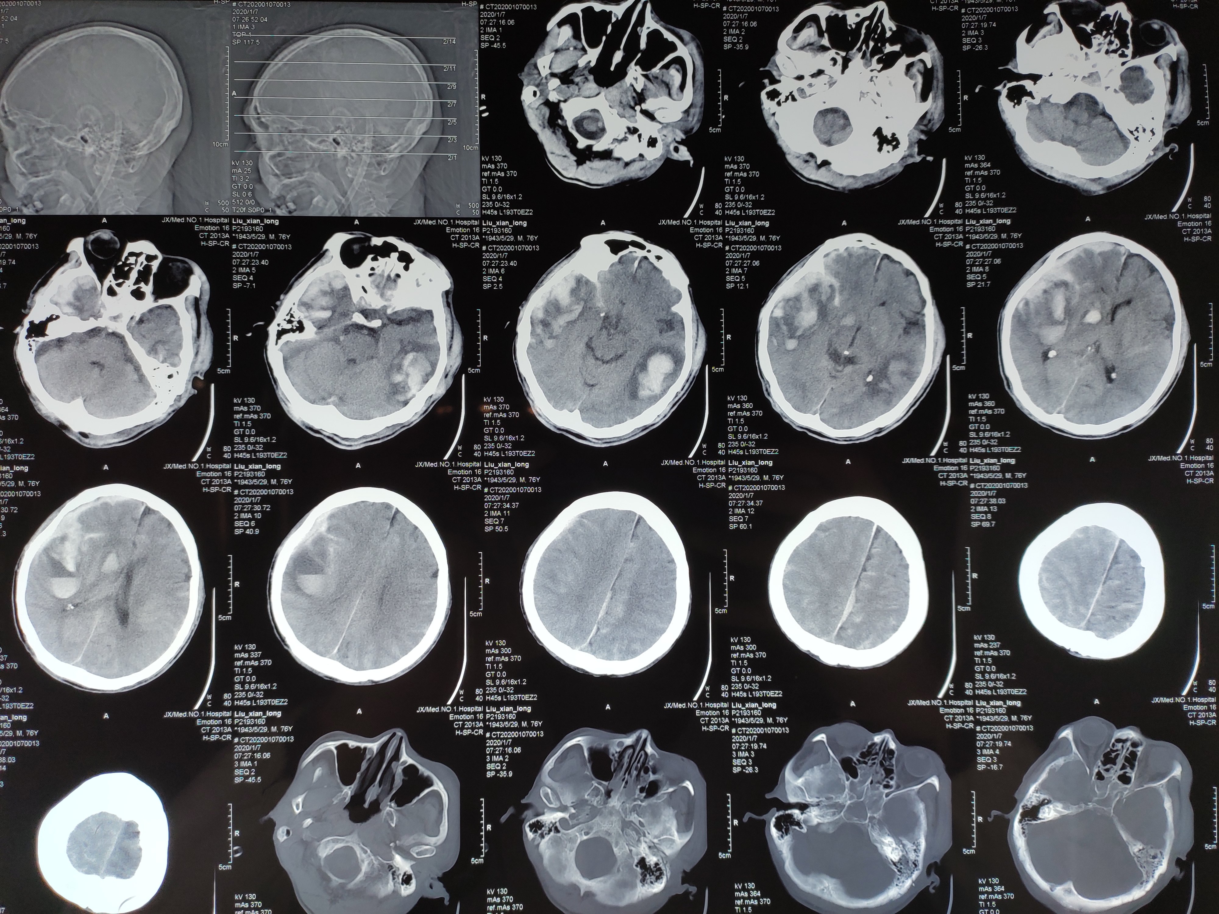 车祸多发脑出血,开刀成功 - 好大夫在线