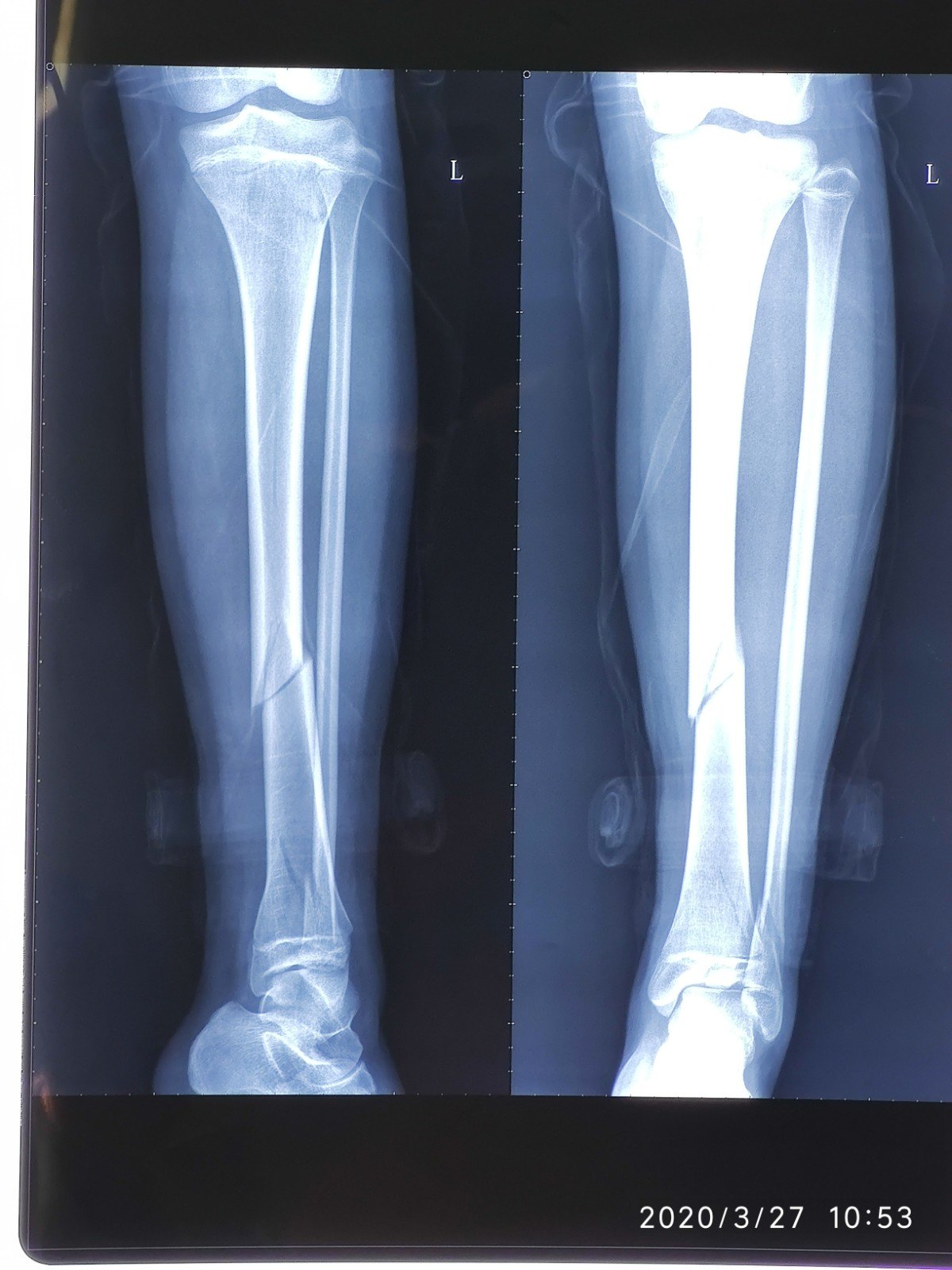 儿童胫腓骨骨折的治疗 胫腓骨骨折 好大夫在线 儿童胫腓骨骨折的治疗 胫腓骨骨折 好大夫在线