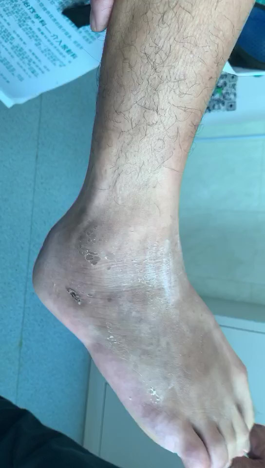 脚踝外伤后很容易肿胀 如何锻炼消肿 我们来看看吧 踝部扭伤 踝部扭伤 脚踝外伤后很容易肿胀 如何锻炼消肿 我们来看看吧 踝部扭伤 踝部扭伤