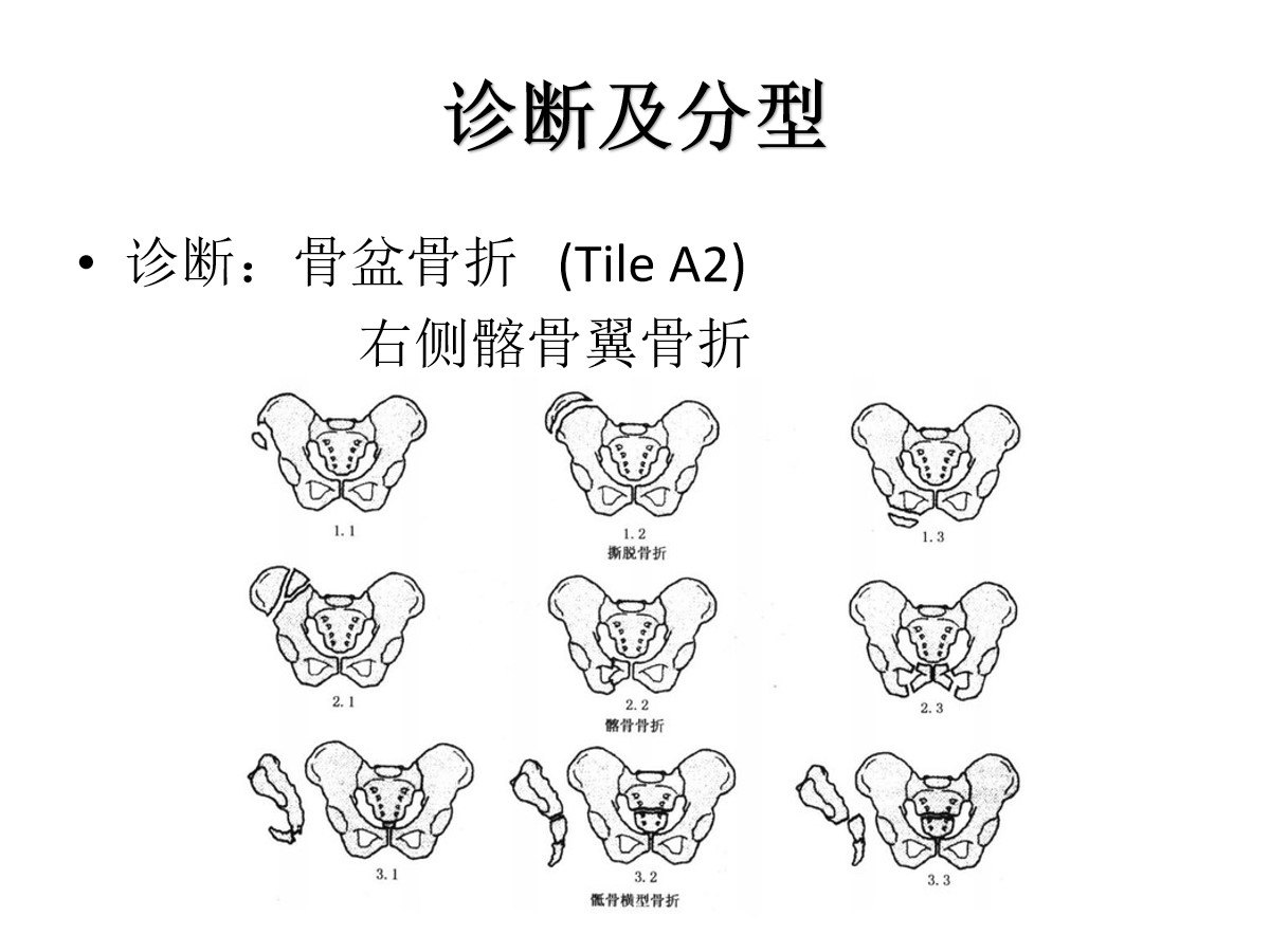 髂骨翼骨折入路图片