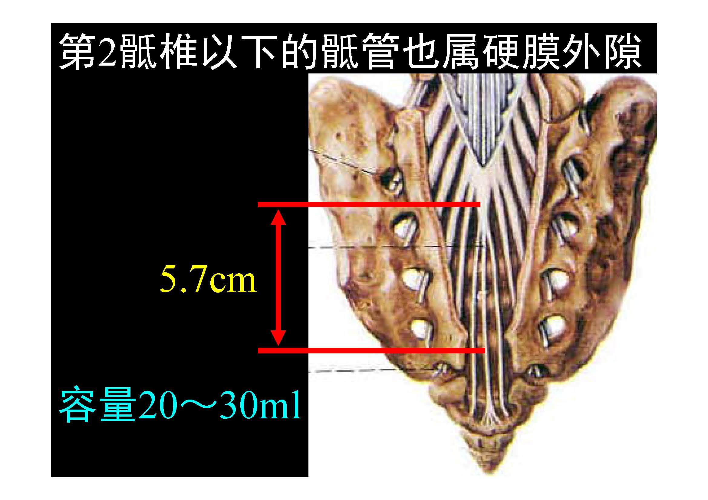 脊椎源性疼痛解剖椎管被膜間隙