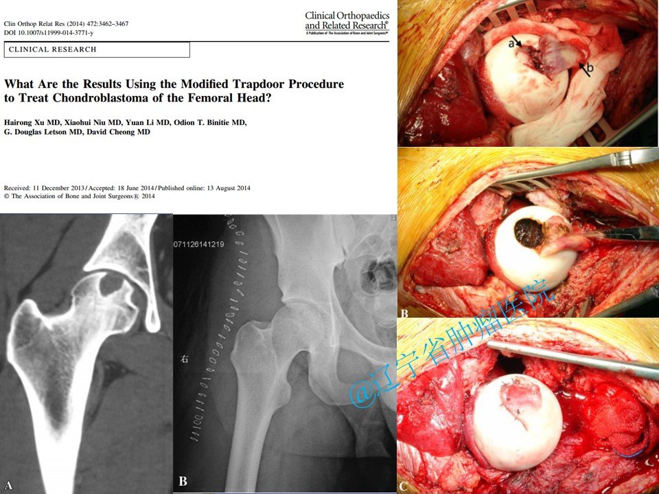 股骨头颈部单纯性骨囊肿手术 - 好大夫在线