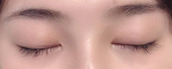 双眼皮术后为什么会出现闭眼不全?