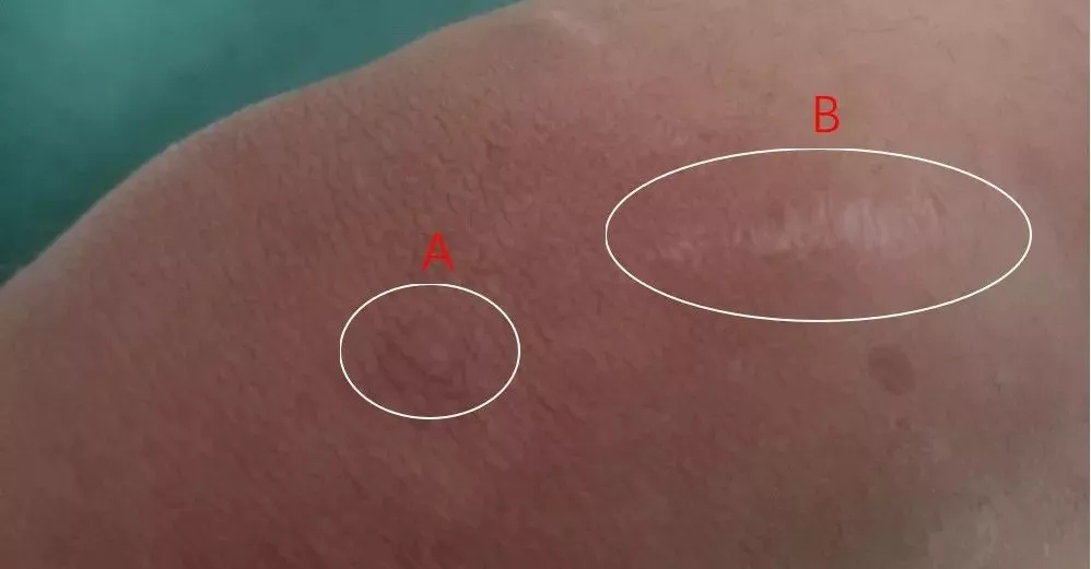 瘢痕是个什么鬼,到底要么样防治?专业的科班医生告诉你!