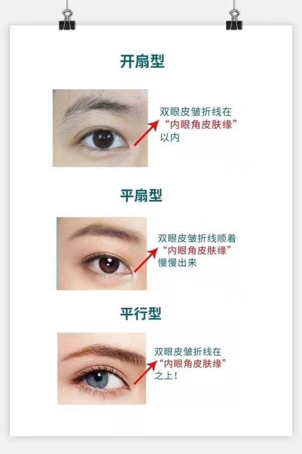 你最适合的重睑形态 - 好大夫在线