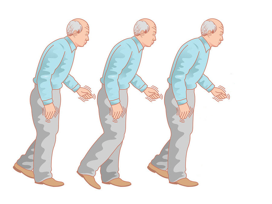 帕金森病:有一种症状比手抖更重要