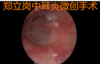 鼓膜小穿孔,首选局麻耳内镜中耳炎微创手术_鼓膜穿孔_鼓膜穿孔治疗