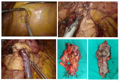 内镜下直肠肿瘤切除术后即行腹腔镜下右半结肠切除,将内镜与腔镜的