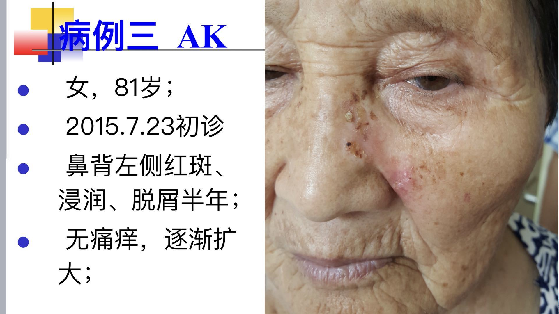 病例分享:日光性角化病 - 好大夫在线